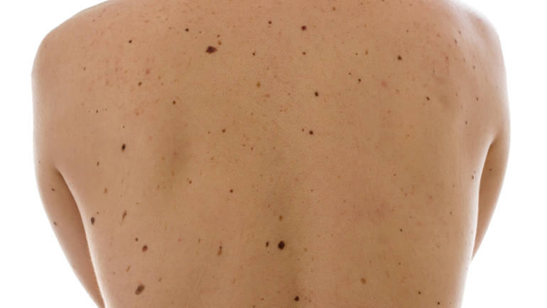 Numbers count in the genetics of moles and melanomas