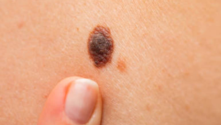 Australian researchers find 45 new genetic causes of non-melanoma skin cancers