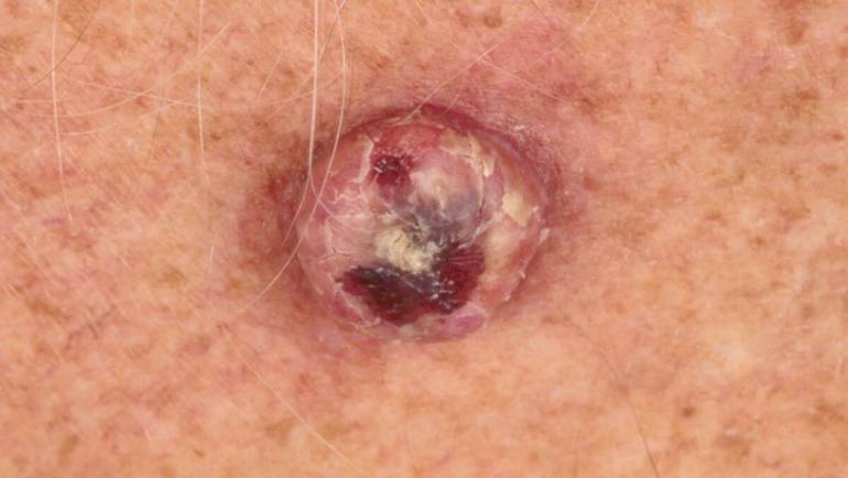 Study finds ways to reduce the risk of common Queensland skin tumour