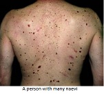Person-with-many-naevi.jpg