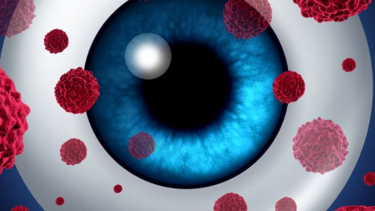 New genetic clues in eye cancer