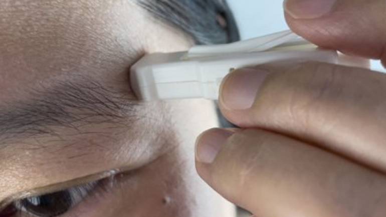 UQ microbiopsy deal could change the way skin conditions are diagnosed